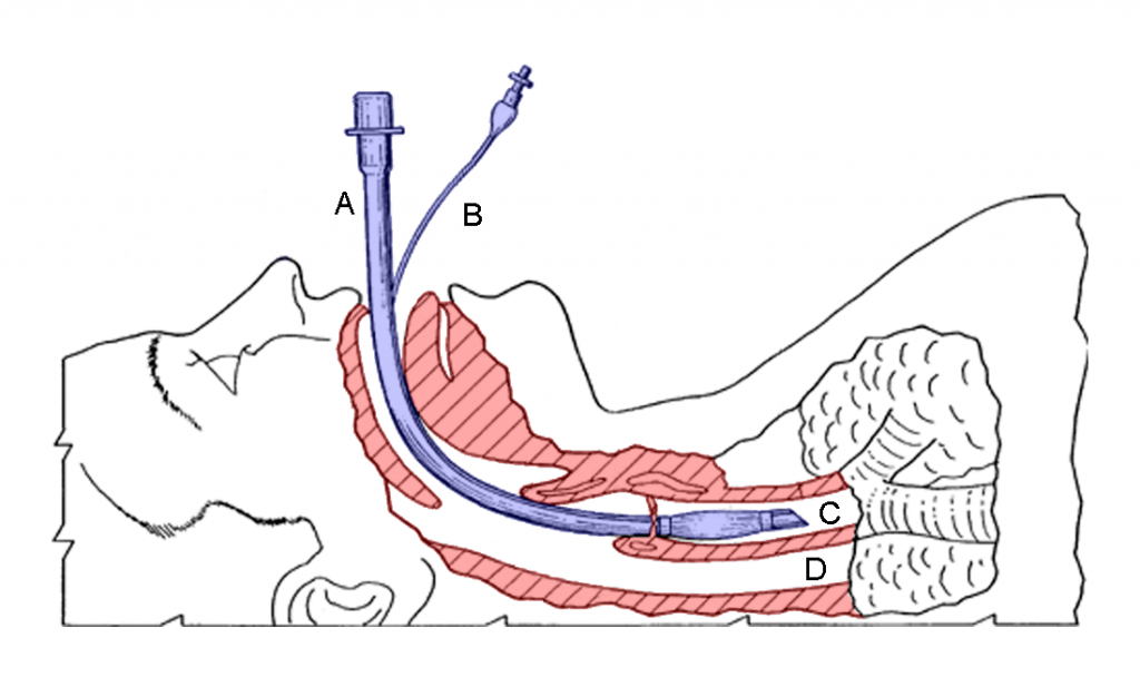 Endotracheal_tube_colored Critical Care Practitioner